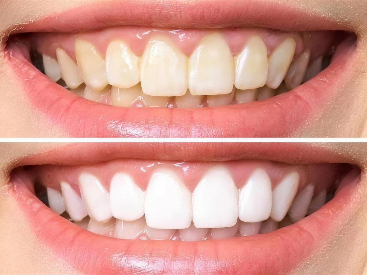 Blanchiment dentaire à Marrakech — Un éclat naturel, sans agresser l'émail · Dentiste à Marrakech, clinique dentaire Ocre