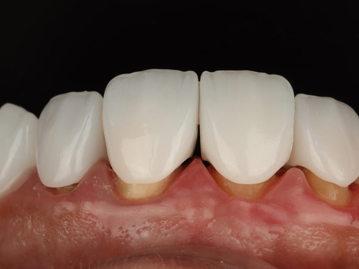 Couronne zircone à Marrakech — Solidité et esthétique sans métal · Dentiste à Marrakech, clinique dentaire Ocre
