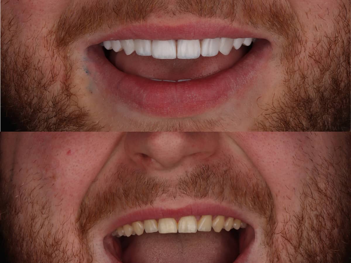 Facettes composite à Marrakech — Sculptées à main levée, sans tailler la dent · Dentiste à Marrakech, clinique dentaire Ocre