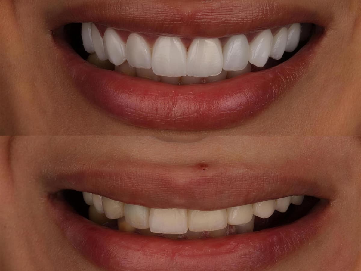 Facettes Emax à Marrakech — La référence en céramique pour un sourire d'exception · Dentiste à Marrakech, clinique dentaire Ocre