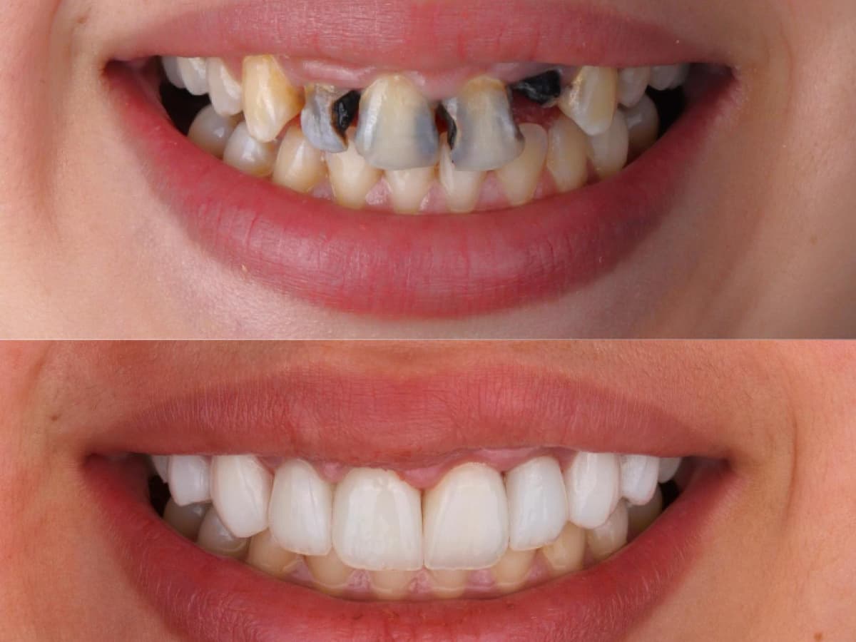 Réhabilitation du sourire à Marrakech — Hollywood Smile — un sourire entièrement redessiné · Dentiste à Marrakech, clinique dentaire Ocre
